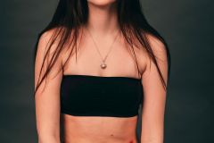 ENDOMETRIOSIS
